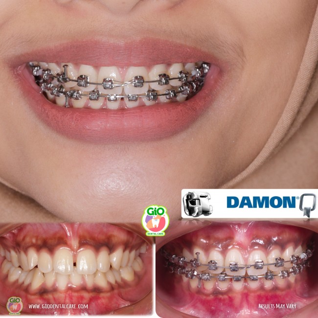 gio-self-ligating-braces